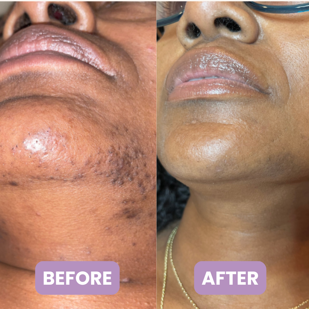RootSilence - Menopause Mustache & Chin Hair Serum